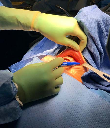 Hands of surgeon reaching in patient’s mouth marking where they will perform surgery