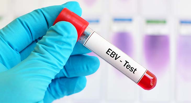 Test tube with blood sample for Epstein-Barr virus (EBV) test