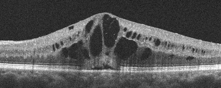 A black and white medical image shows a curved white structure representing layers of tissue within the eye with larger and smaller pockets of darker areas.