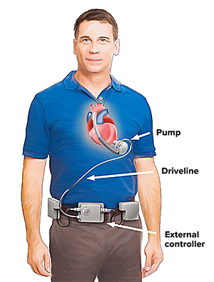 Illustration of a VAD mechanical pump surgically implanted below the diaphragm, attached to the left ventricle and aorta, and powered by external batteries.