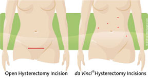 open surgery vs. robotic-assisted surgery incisions