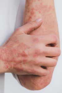 Psoriasis on arm and hand (c) UC Regents. All rights reserved.