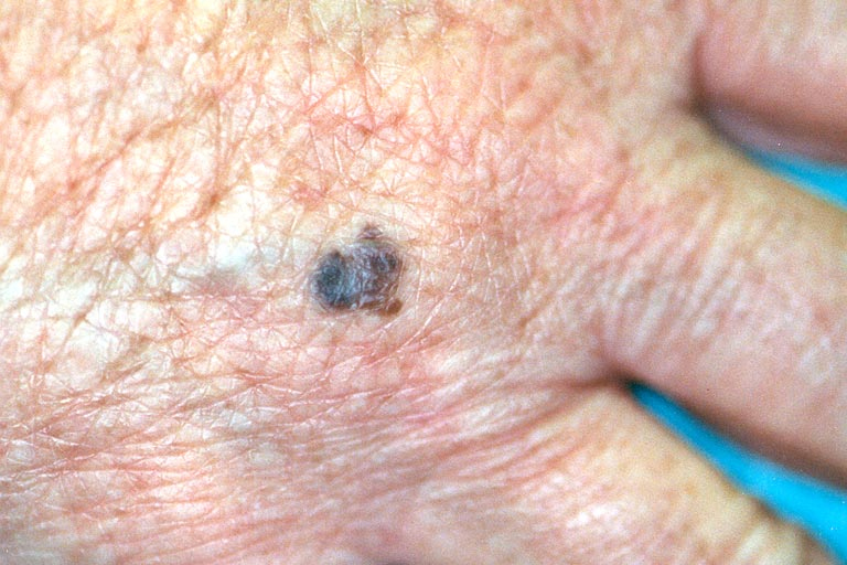 Melanoma DOJ Photo