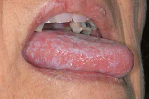 white skin inside of cheek