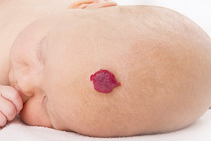 Pediatric Dermatology image