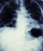 chest x-ray