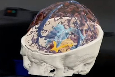 Partial skull and brain scan displayed using 3D virtual glasses.