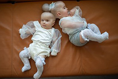 Conjoined twin babies on a sofa.
