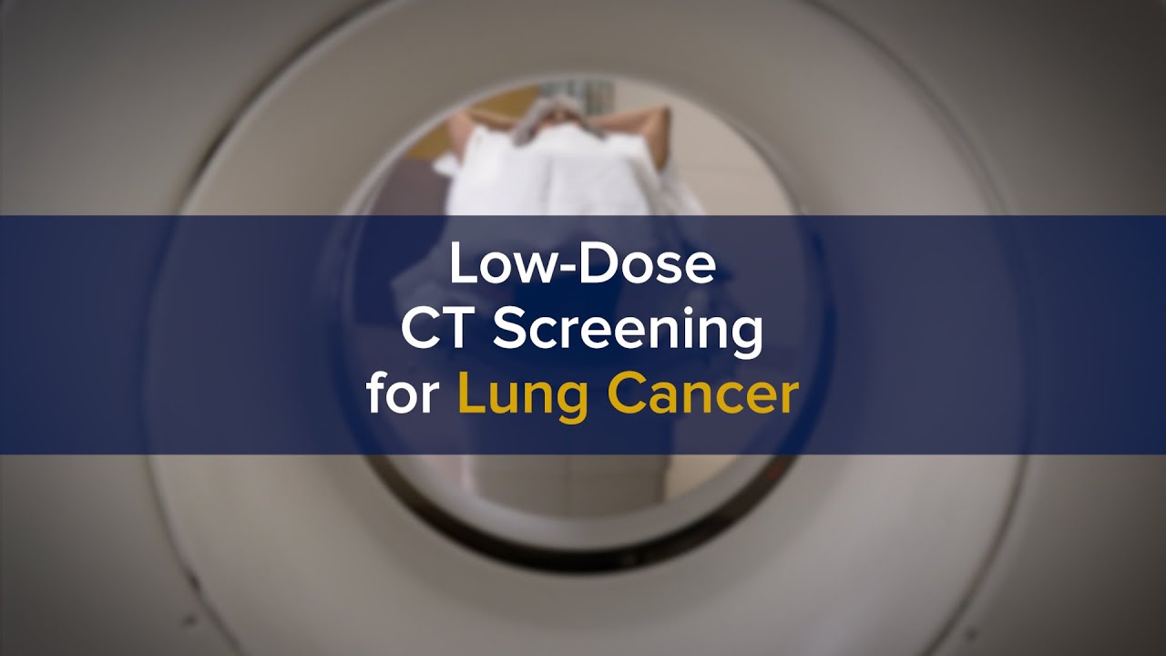 Patients for Lung Cancer Screenings