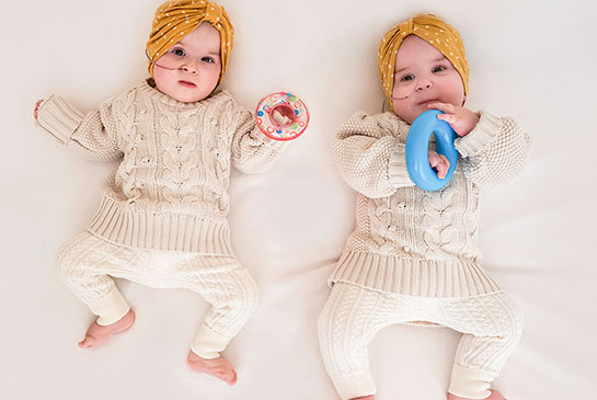 Twins Abigail and Micaela after fetal surgery to separate conjoined heads