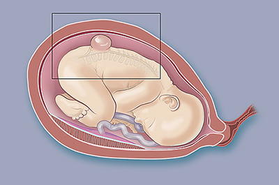 An illustration of a child in a womb with spina bifida.