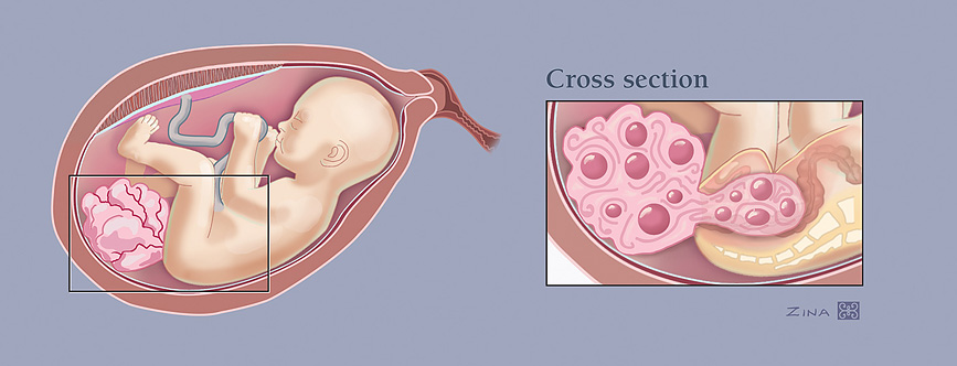Illustration of Sacrococcygeal teratoma