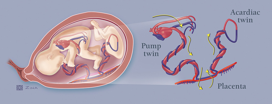 Illustration of Twin-reversed arterial perfusion syndrome