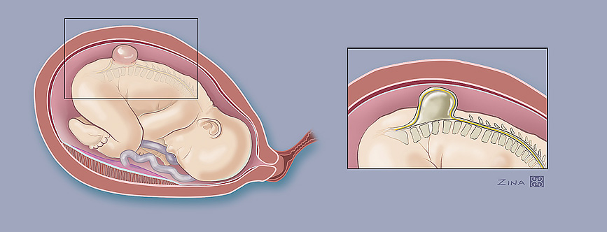 Illustration of Spina bifida