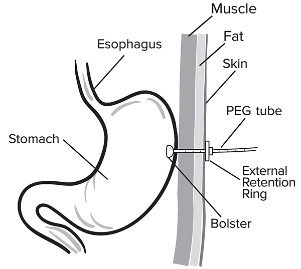 Percutaneous Endoscopic PEG tube