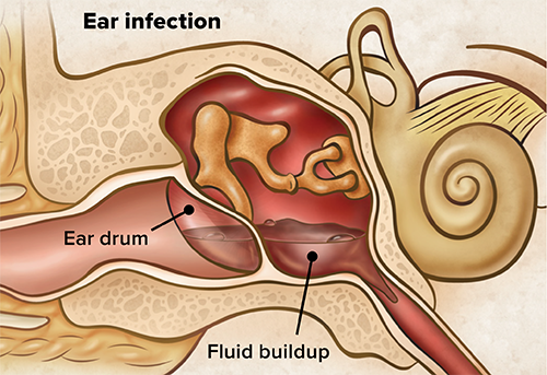 ear with fluid