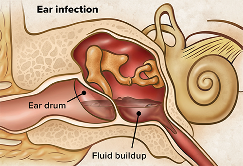 tubes in ears