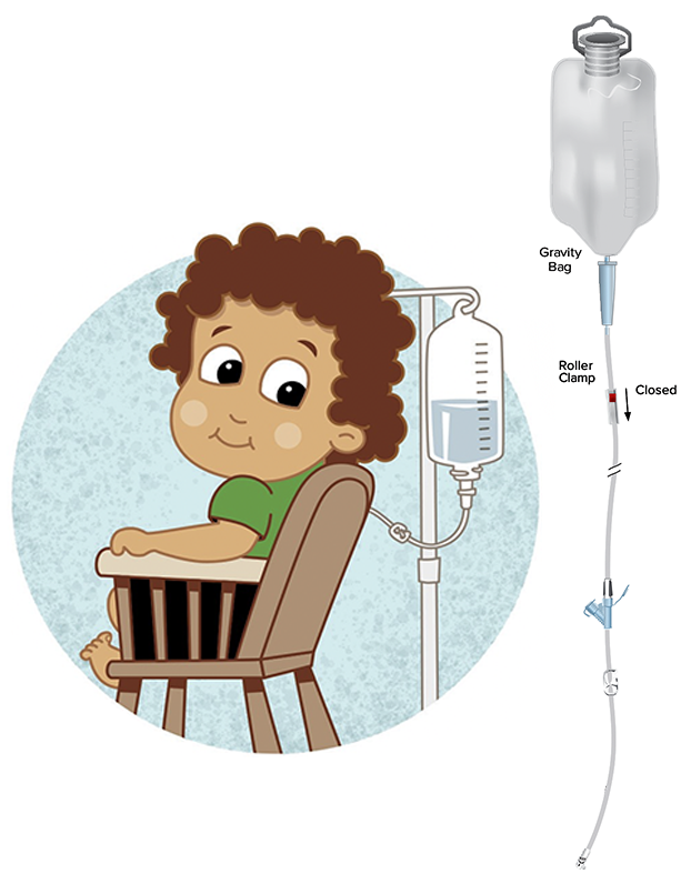 An Introduction to Your Child's Gastrostomy Tube | Patient Education | UC  Davis Children's Hospital