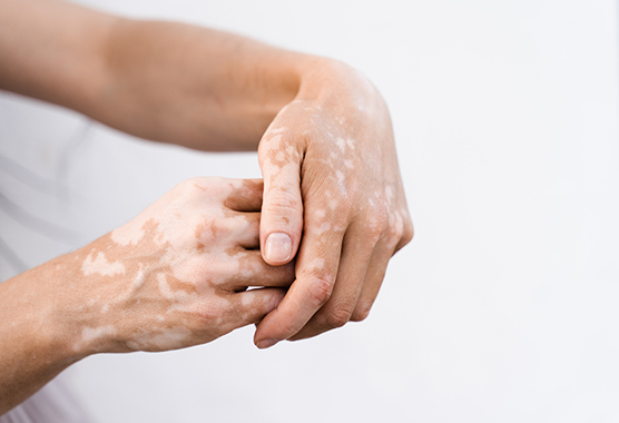 Hands with vitiligo.