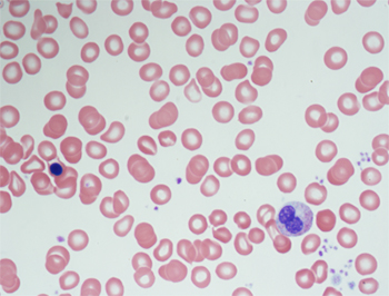 Nucleated red blood cell on the left and immature white blood cells on the right 