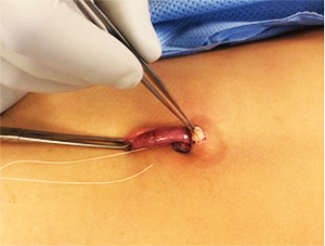 The new appendicostomy procedure preserving the tip of the appendix and its vessels.
