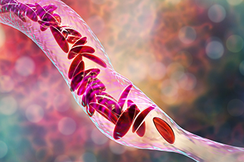 Sickle cell disease causes ballooning, changes in diameter and other abnormalities in blood vessels 