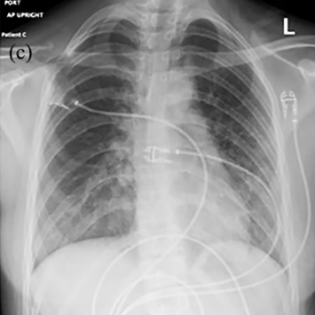 Chest X-ray image of patient with lung injury due to vaping. 