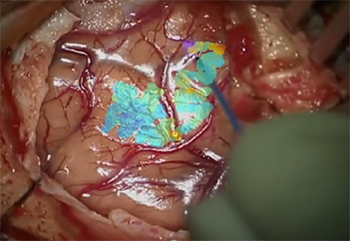 The FLIm system shows the autofluorescence of brain tissues with potential cancerous tumor