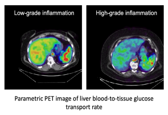 PET scan of liver with inflammation 