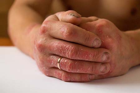 Two hands with psoriasis