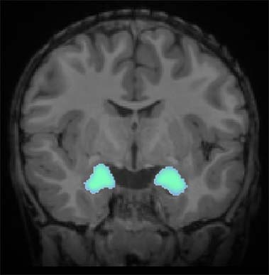 The amygdala (highlighted) is a small almond-shaped structure in the brain