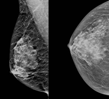 2D images from a false positive mammogram