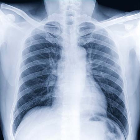 Chest X-ray image of a human chest