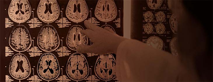 A hand points at a series of MRI images of the human brain.