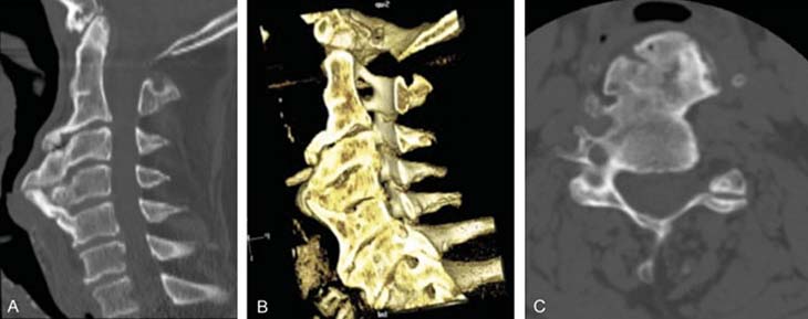 Three images of bones showing bone spurs.