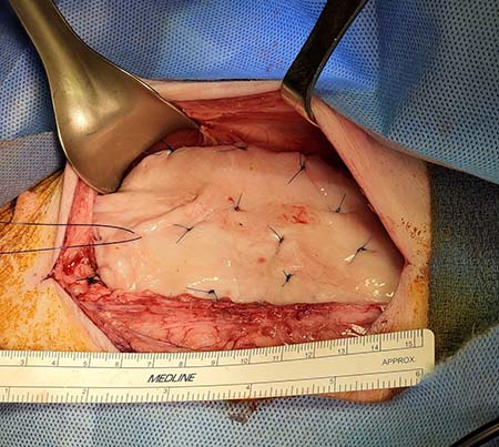 a surgical procedure of implanting a graft on top of the rectus muscle.
