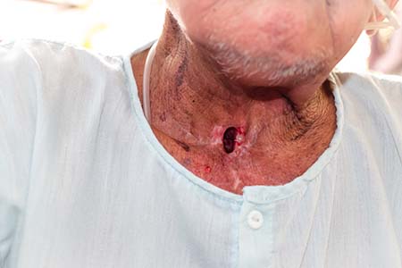An older male patient with a stoma opening in his neck 