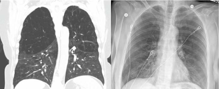Two images of Patrisa Williams lungs showing emphysema