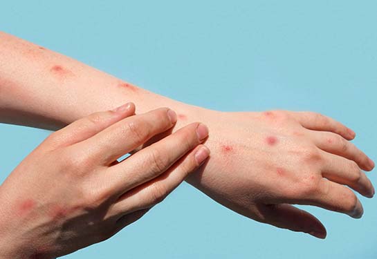 An arm depicting the monkeypox rash
