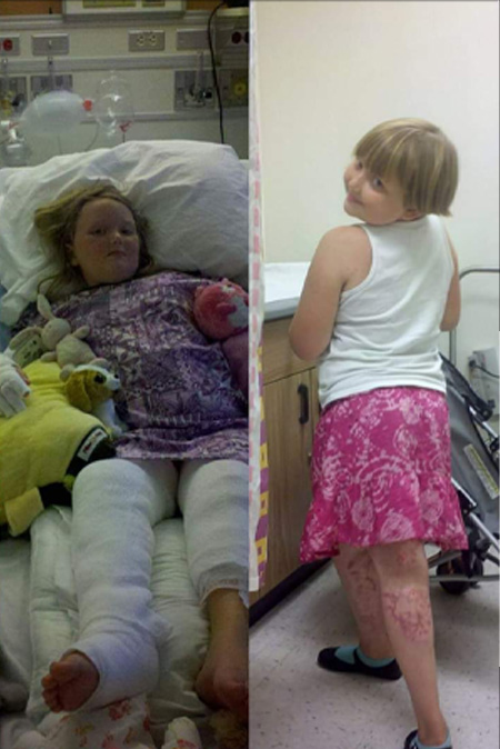 Rayne Carr lies in hospital bed with bandages on leg on left. In another photo, Rayne wears shorts exposing burn scars while smiling at camera.