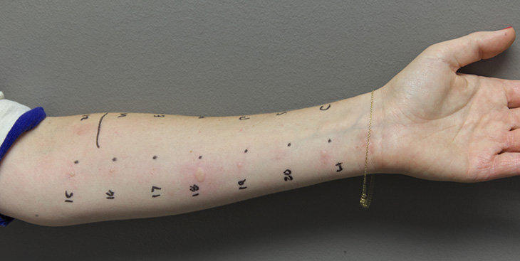 skin allergy testing on an arm with dots corresponding to allergens