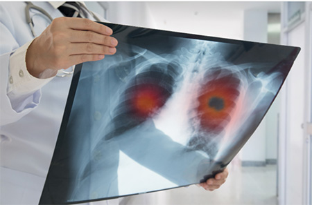a doctor wearing a white coat and holding an Xray of the chest with red spots on lungs