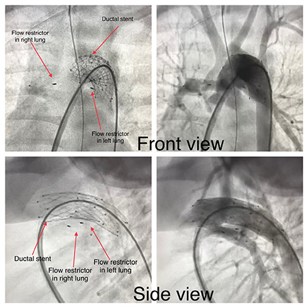 X-ray of Carter's lungs before and after cath procedure
