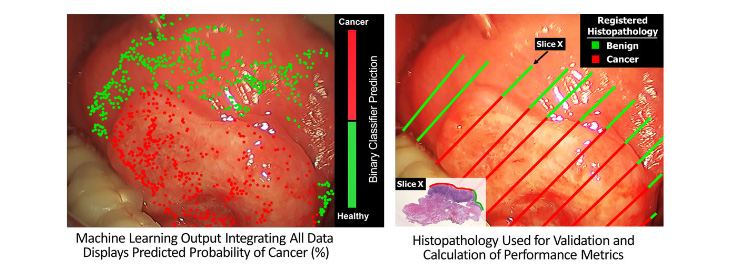 two photos showing FLIm’s prediction of cancer tissues (highlighted in red) and benign tissues (in green)