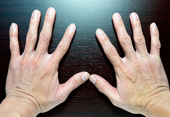 Damaged dry skin on human hands