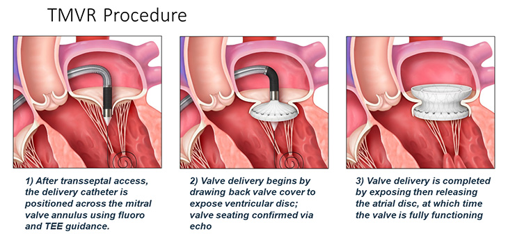 First Transfemoral Mitral Valve Replacement Performed By Heart Team Mirage News