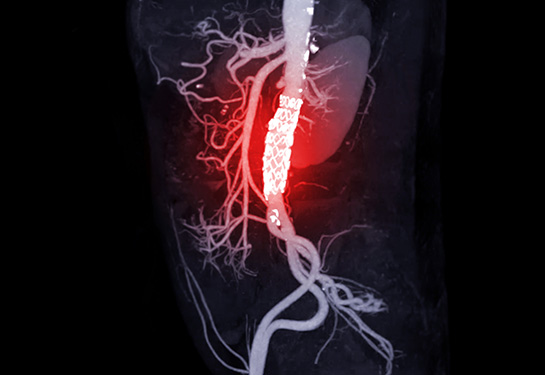 A scan of a patient’s torso, including arteries and organs, on a black background, with heart section highlighted in red and white. 