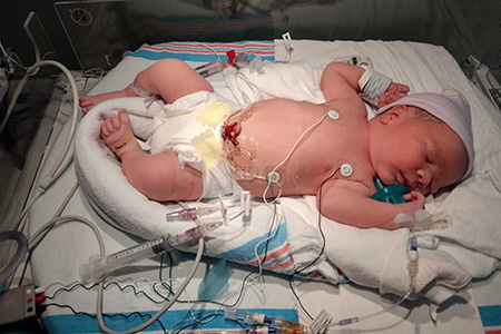 Baby patient in a hospital crib after surgery
