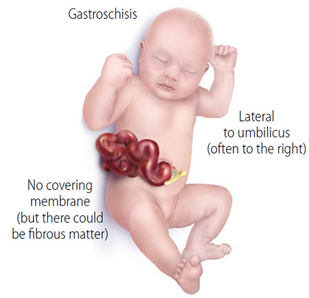 Baby with gastroschisis