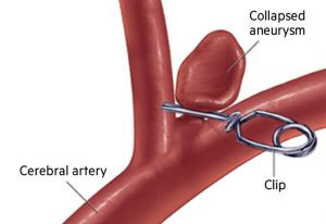 Small clip is placed at the opening of the aneurysm sealing it closed.